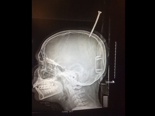 Maryland boy's skull pierced with screw in treehouse-building accident