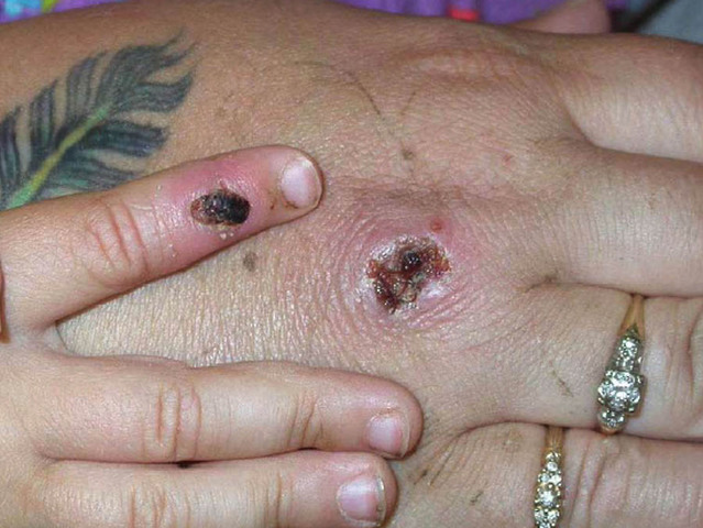 Monkeypox: First cases of rare infection diagnosed in UK